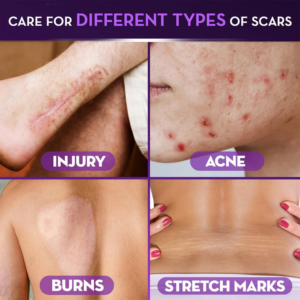 Scar gel care examples on skin showing injury, acne, burns, and stretch marks