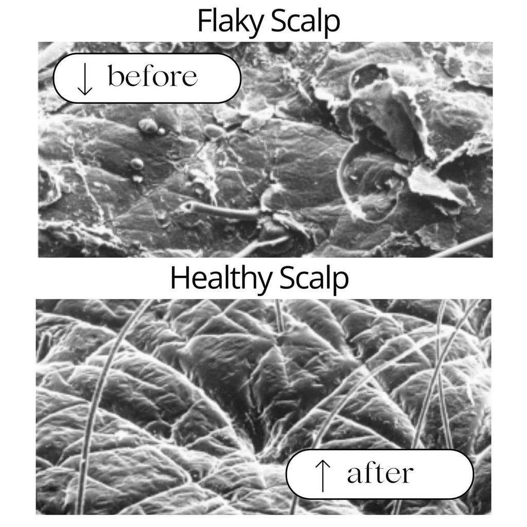 Anti-dandruff shampoo scalp before-and-after infographic: flaky scalp to healthy scalp