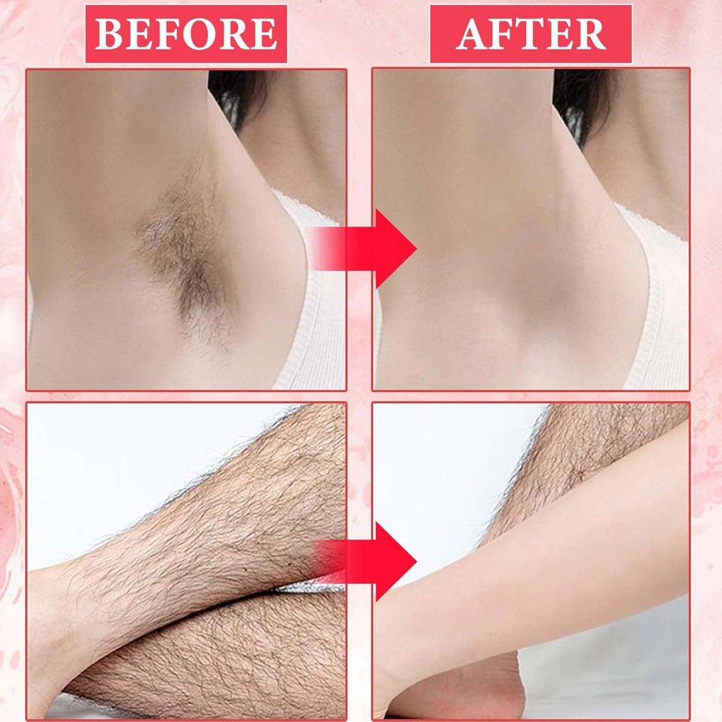 Before-and-after leg hair removal showing reduced hair after cooling gel