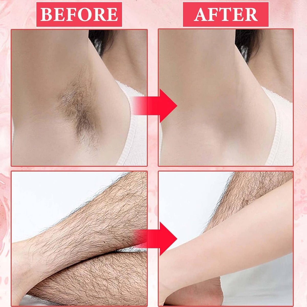 Before-and-after leg hair removal showing reduced hair after cooling gel