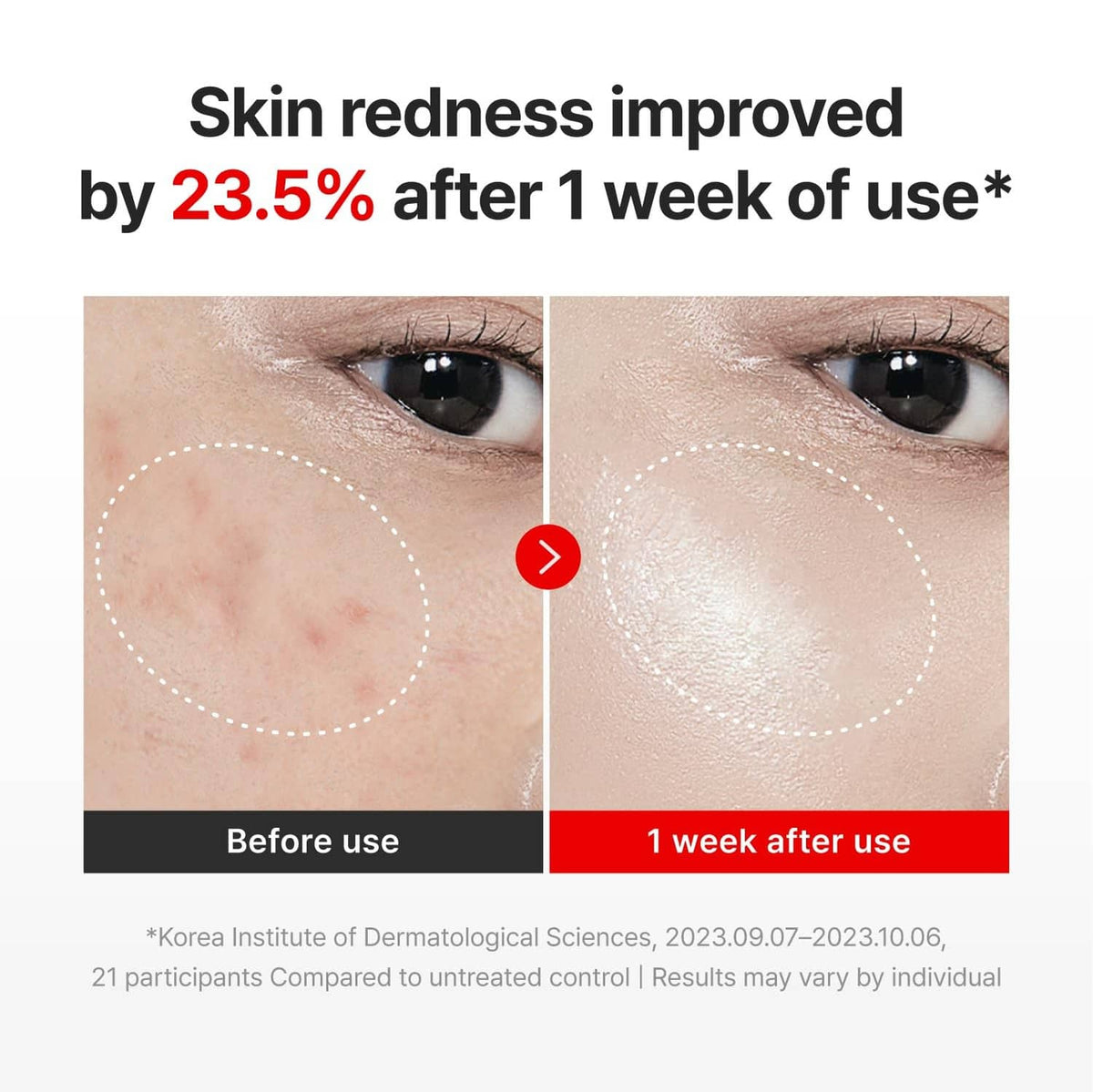 Skin redness before-and-after eye close-up comparison for anti-aging cream