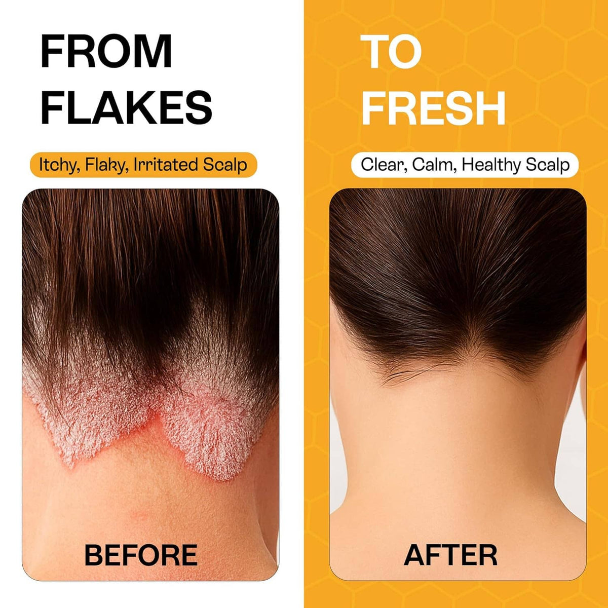 Salicylic acid scalp shampoo before-and-after flaking reduction on scalp