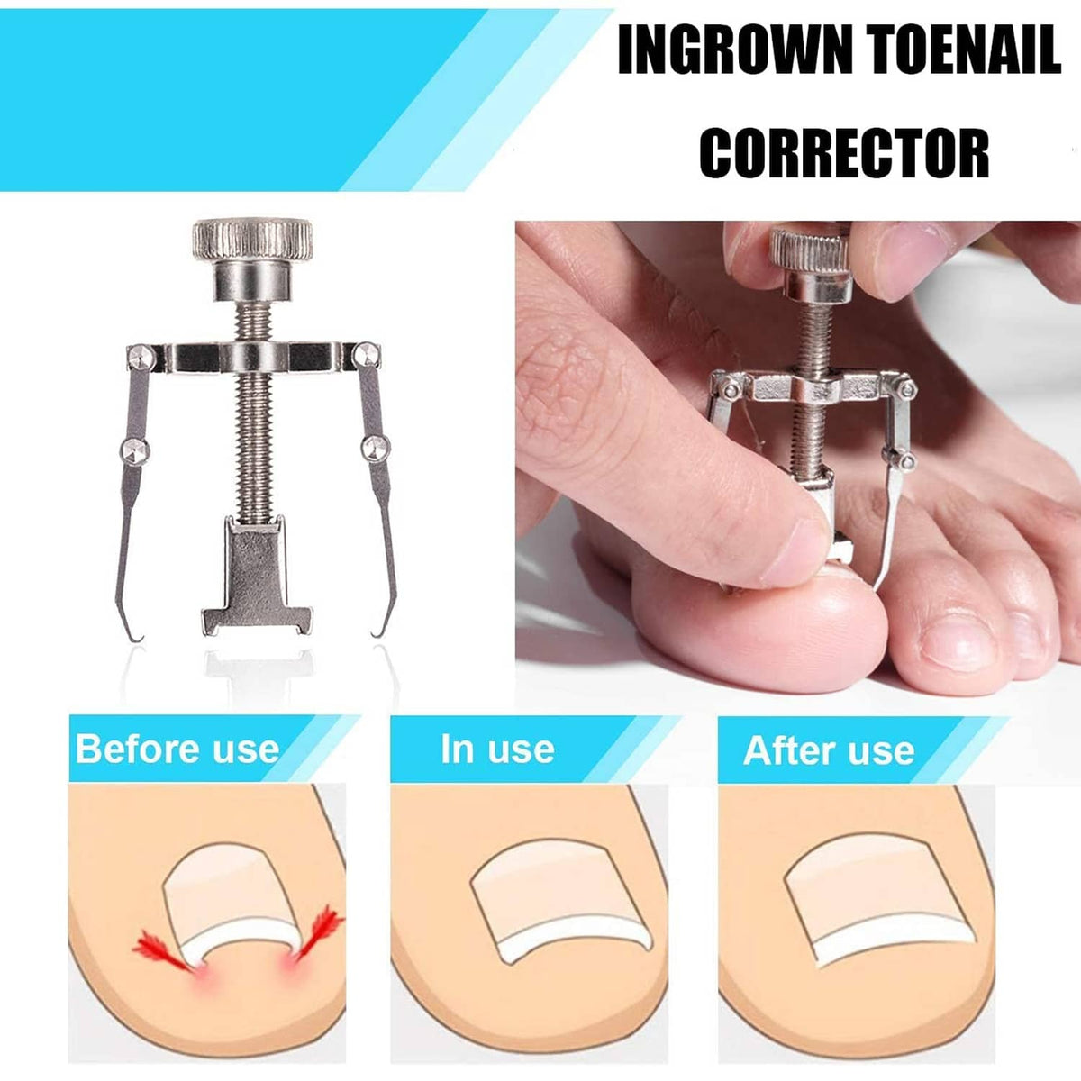 Ingrown toenail corrector device with screw clamp and curved support frame