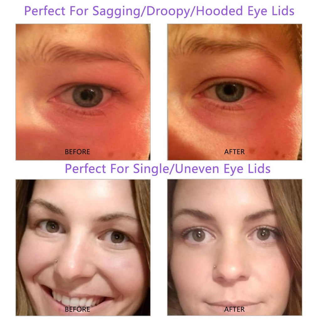 Before-and-after close-up showing eyelid tape lifting sagging or uneven eyelids