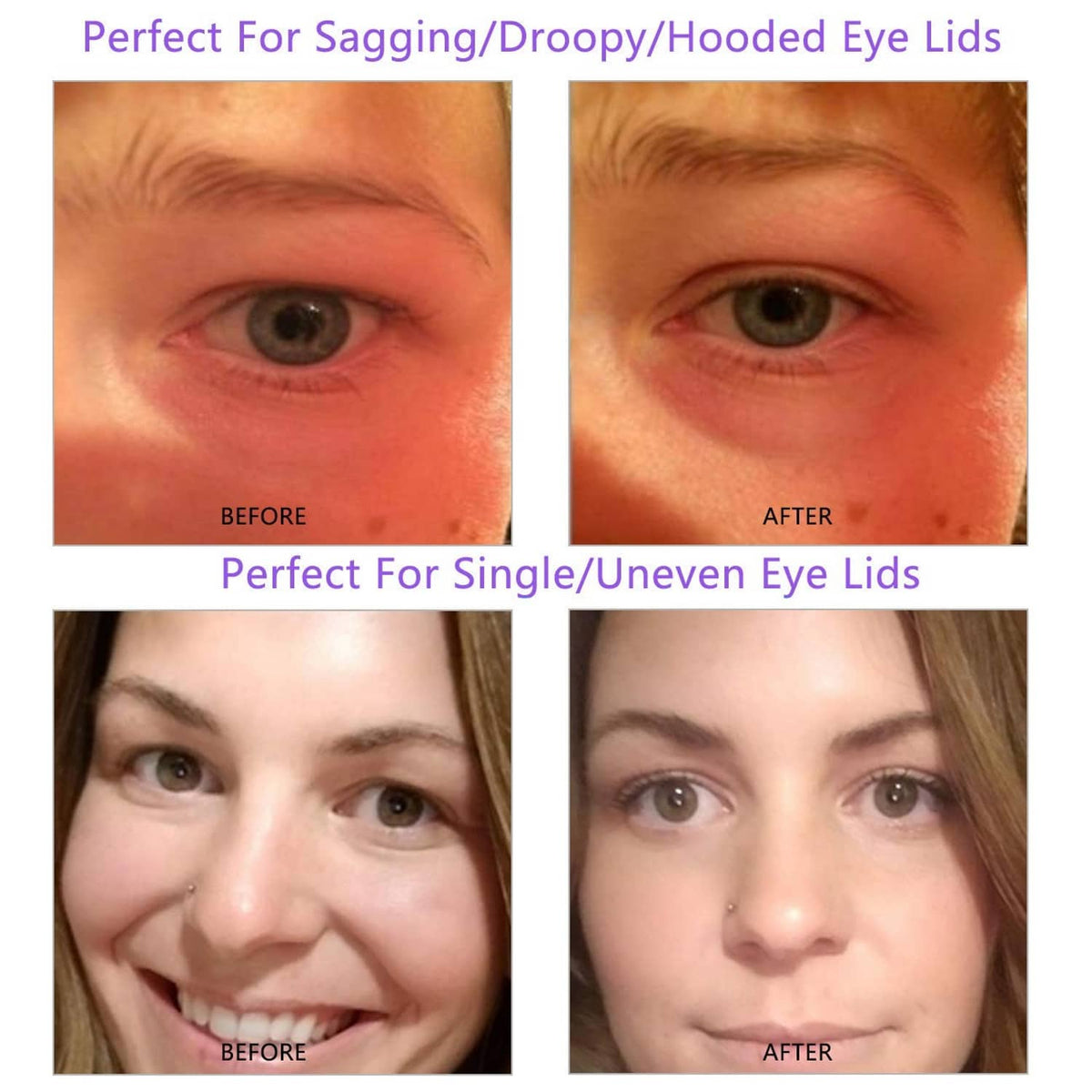 Before-and-after close-up showing eyelid tape lifting sagging or uneven eyelids