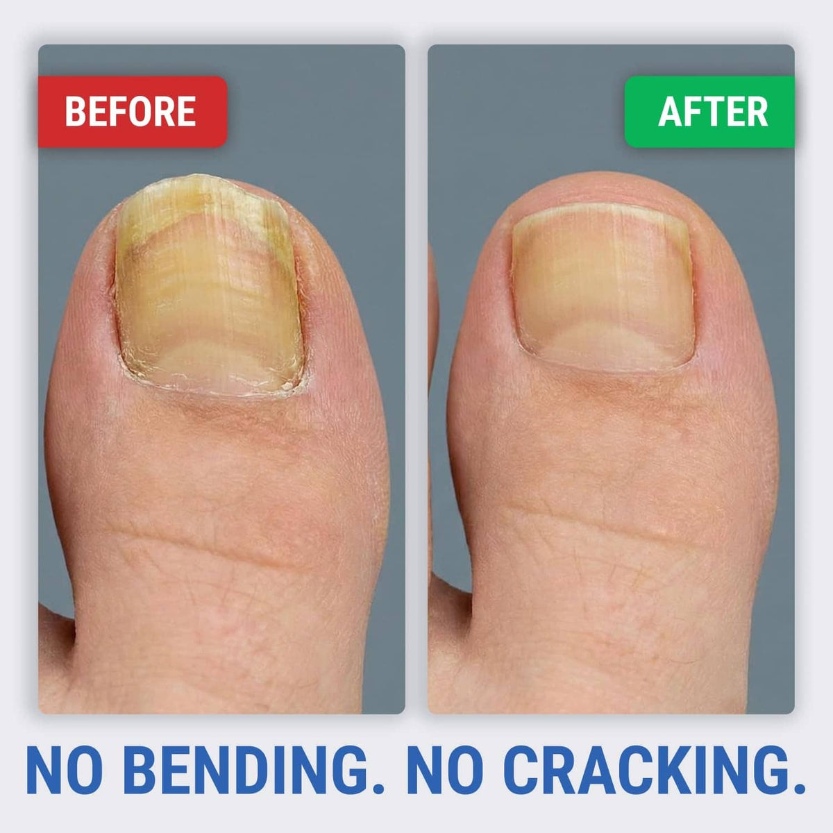 Before-and-after view of thick toenail trim results with KLIPP clippers