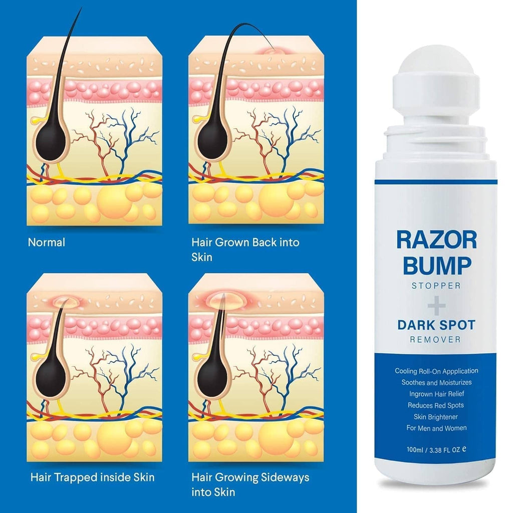 RivetOak Razor Bump Stopper with Ingrown Hair Treatment: 3.38 Fl Oz (Pack of 1), White