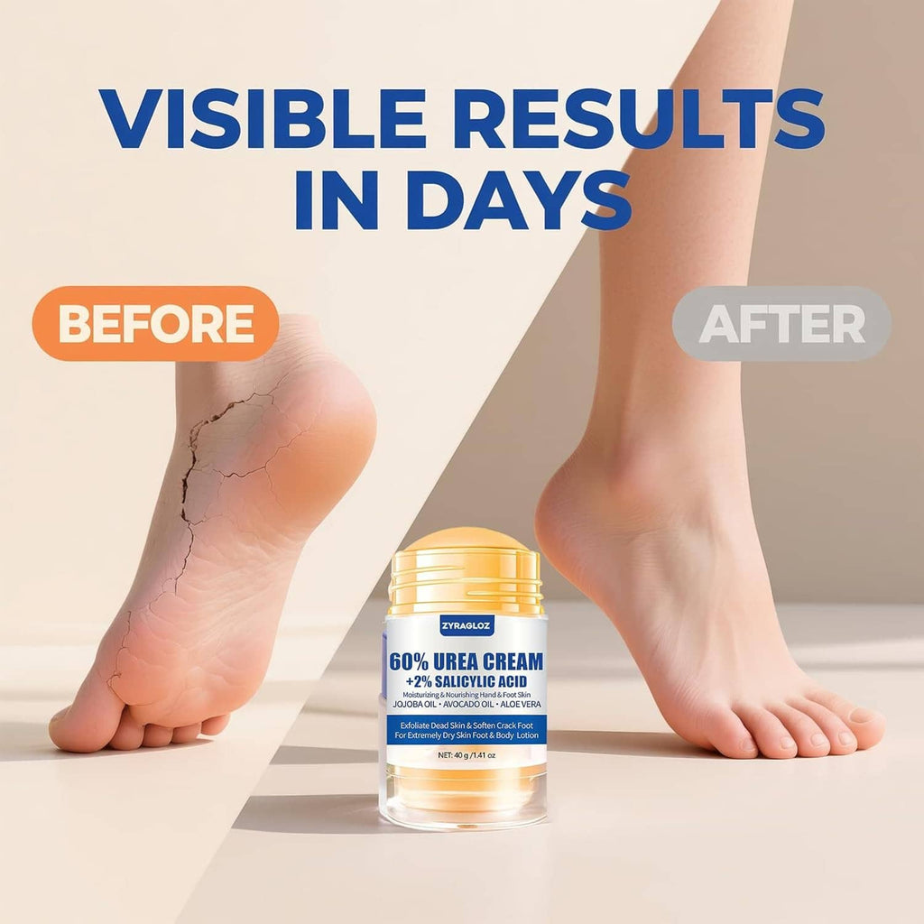 Urea cream jar centered between foot before and after views