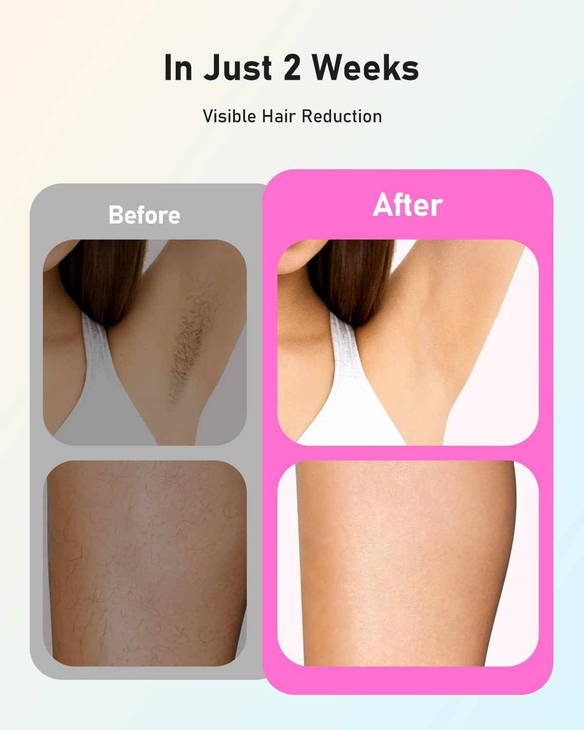 At-home IPL hair removal before-and-after chart labeled “In Just 2 Weeks”
