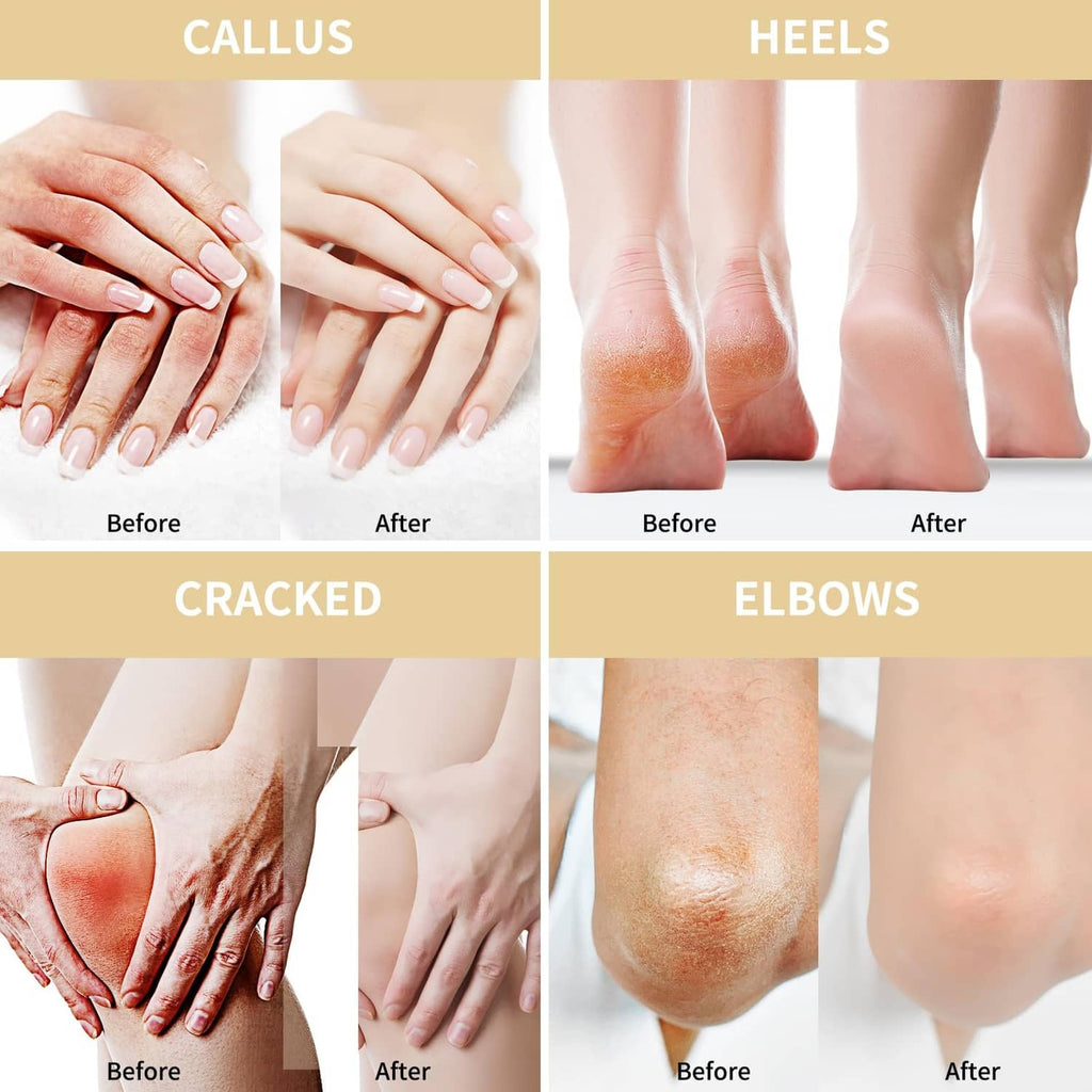 Before-and-after skin panels for callus, heels, cracked feet, and elbows