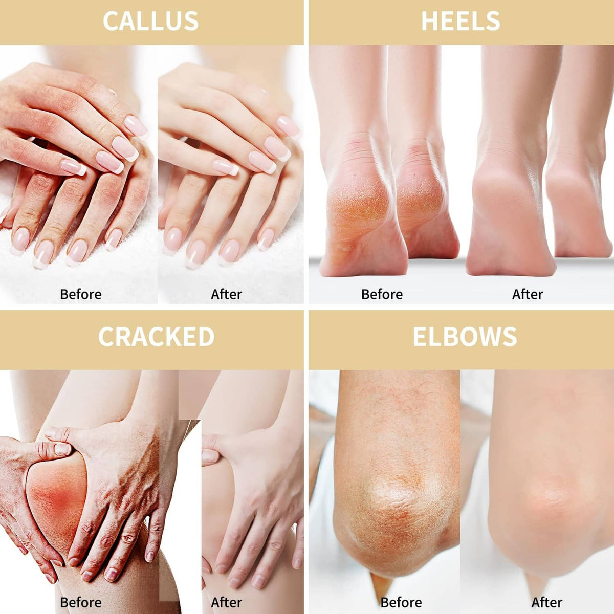 Before-and-after skin panels for callus, heels, cracked feet, and elbows