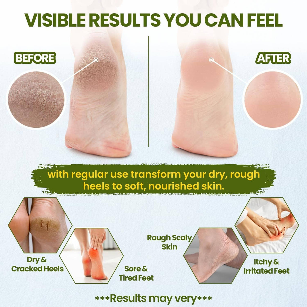 Tea tree balm tin with before-and-after foot skin results graphic