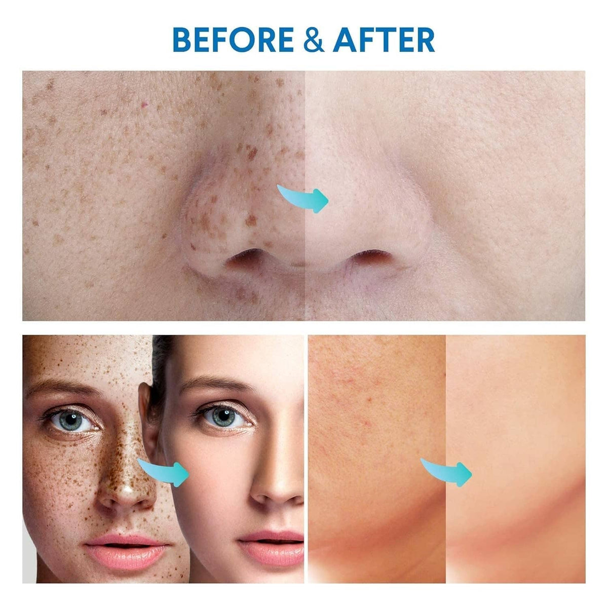 Before-and-after skin close-up showing reduced dark spots