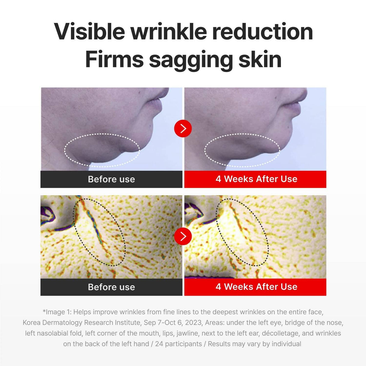 Neck and face before-and-after firmness comparison with dotted treatment areas