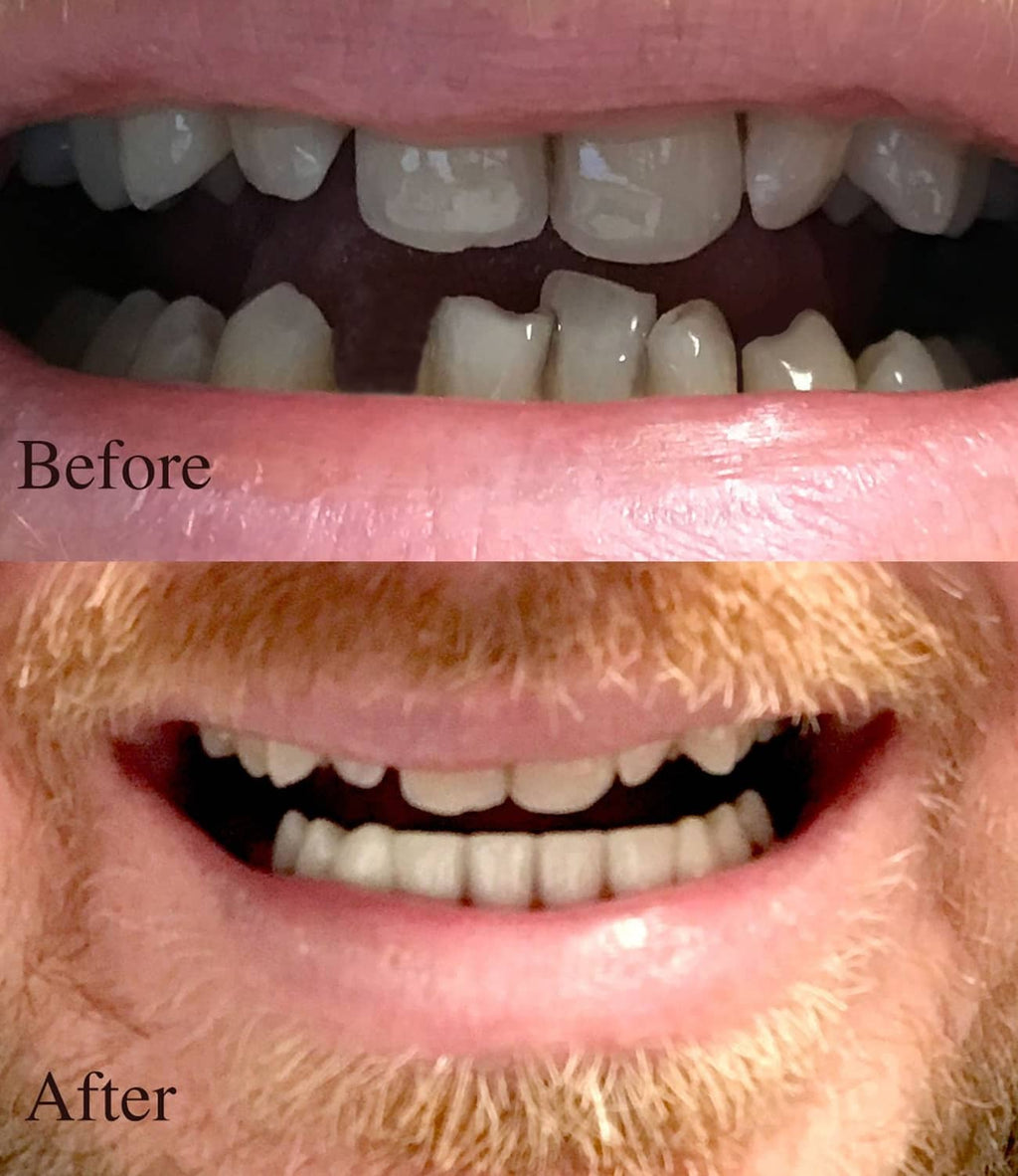 Cosmetic lower teeth set fitted in mouth, showing white teeth on pink gum base.