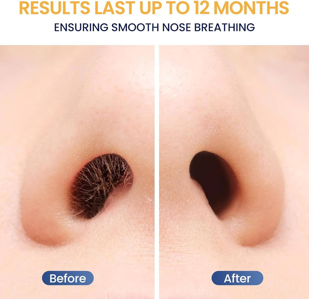 Nostrils before-and-after skin area comparison with reduced hair appearance