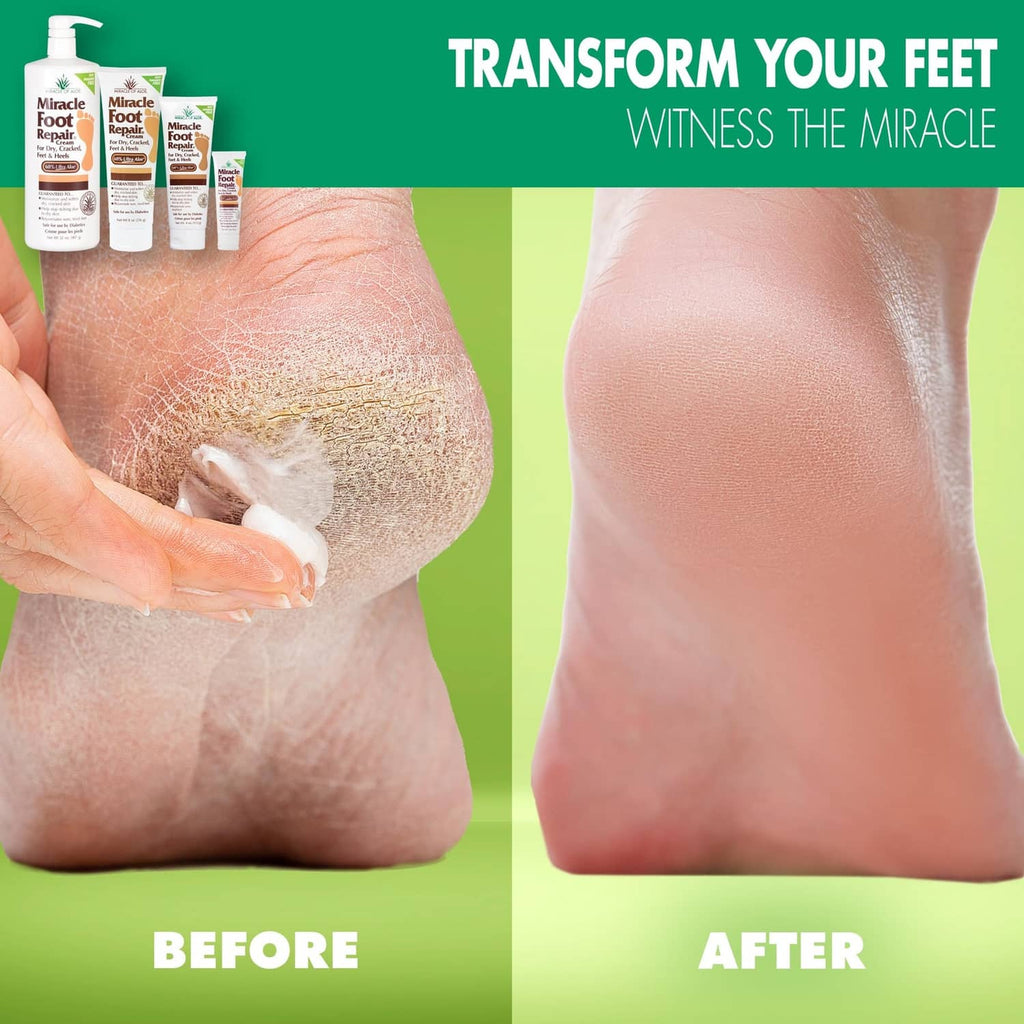 Foot repair cream before-and-after view: dry heel and smoother foot