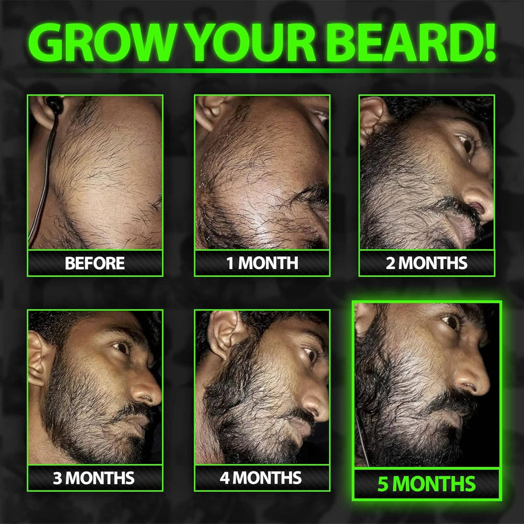 Beard growth results collage showing before and after beard photos over 1 to 5 months