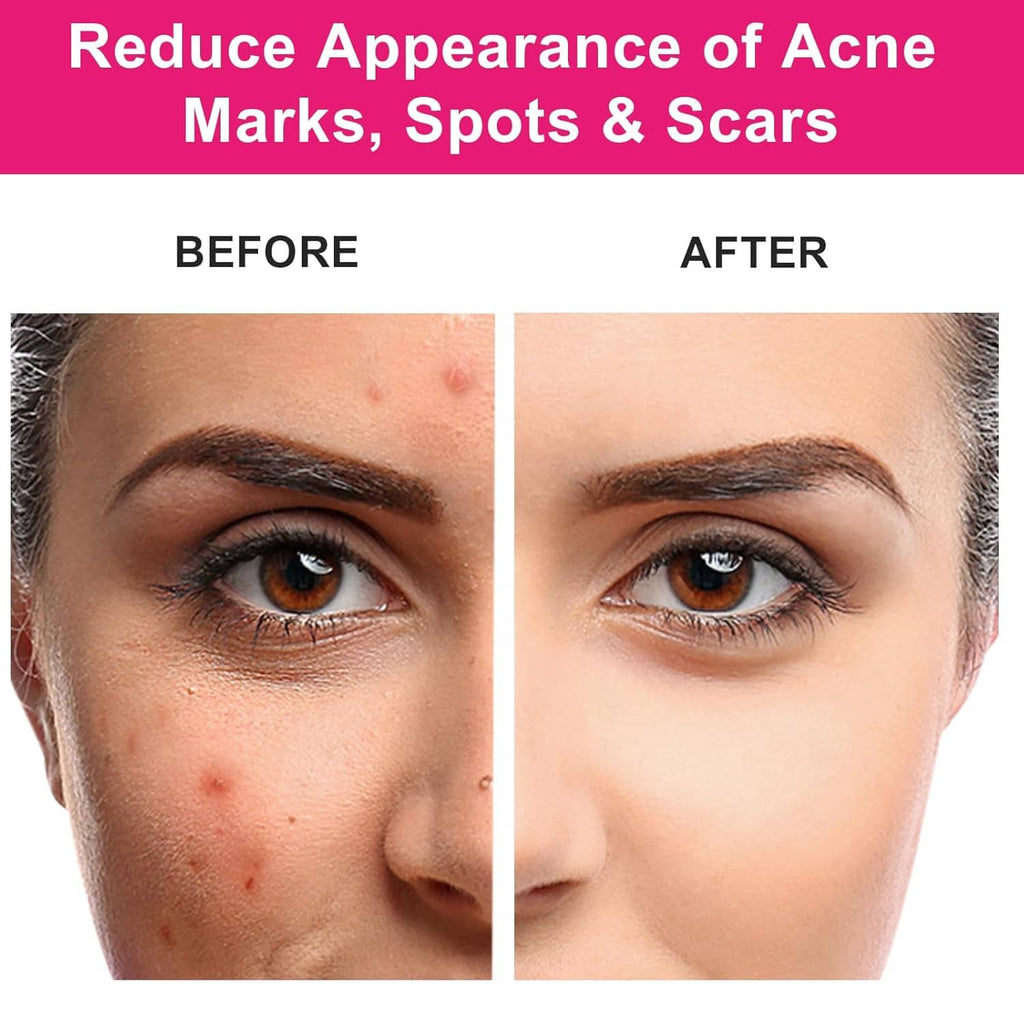 Rosehip seed oil skincare results shown in acne mark before-and-after halves