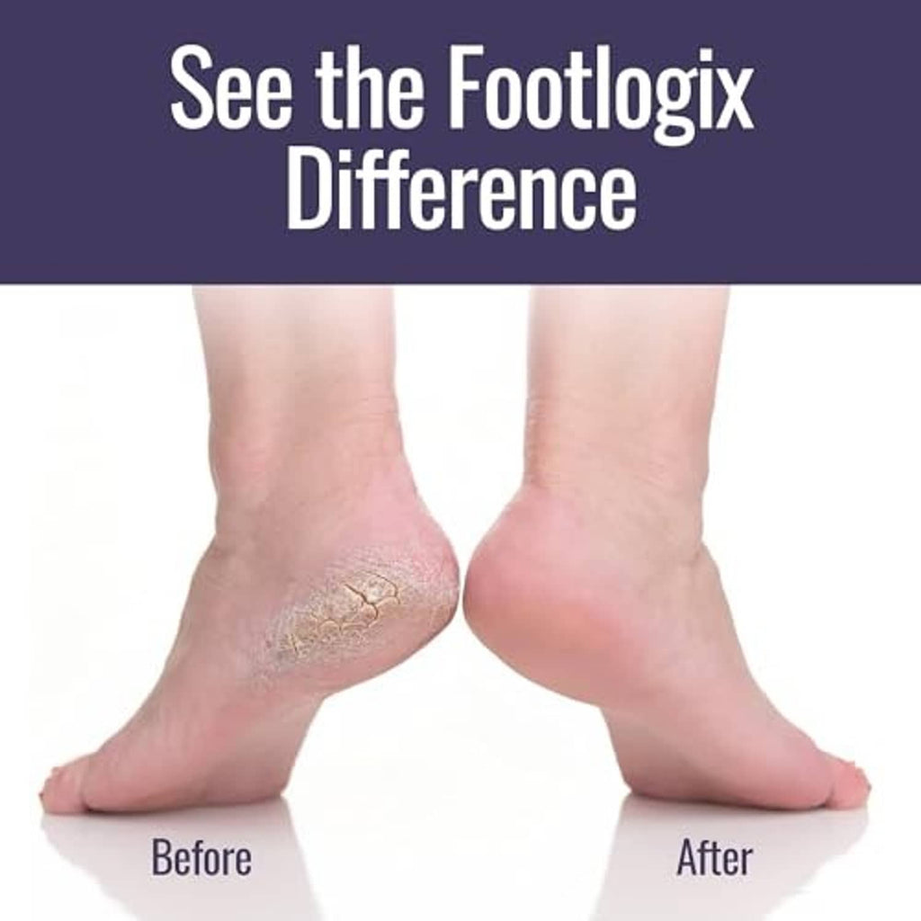 Bare feet with callused heel area plus callus softener spray and foot file