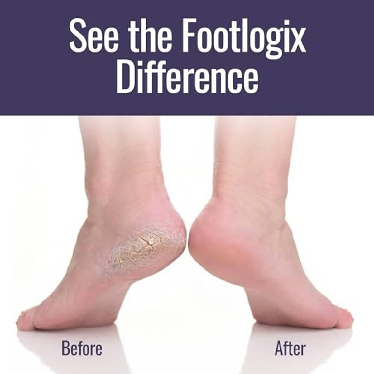Bare feet with callused heel area plus callus softener spray and foot file