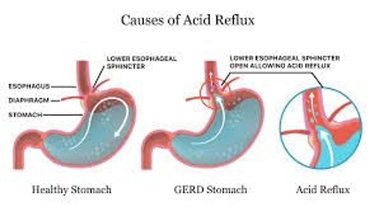 Diagram comparing healthy stomach and GERD stomach with acid reflux arrows