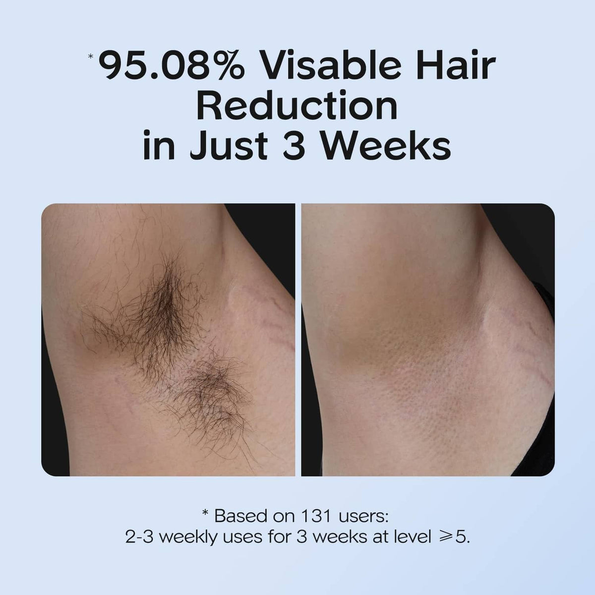 IPL hair reduction comparison graphic with two leg skin areas