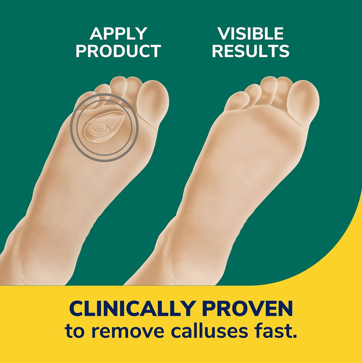 Callus remover seal & heal bandage application on bare foot
