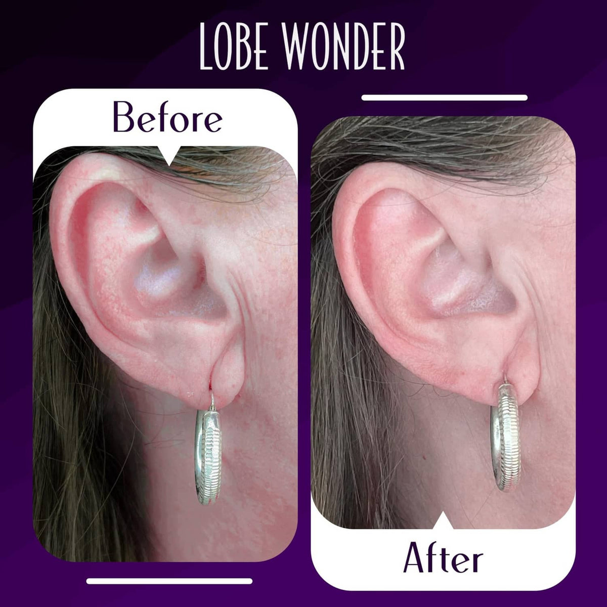 Clear ear support patch on an earlobe, shown before and after with hoop earring