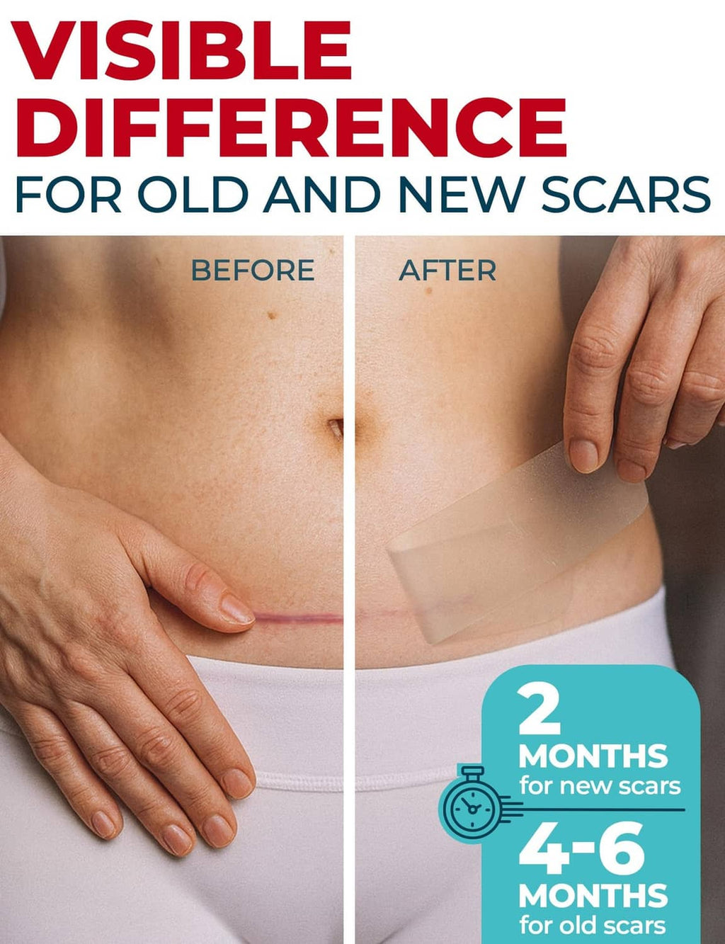 Transparent silicone scar sheet applied to abdomen skin, visible adhesive layer
