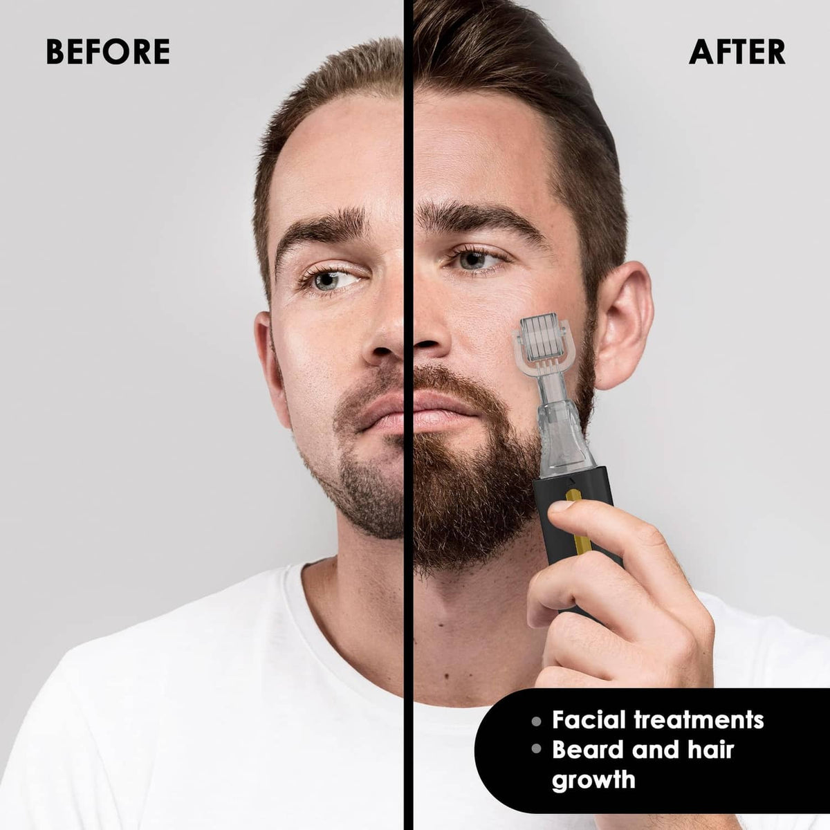 Facial and beard grooming derma roller held to skin on a split before/after
