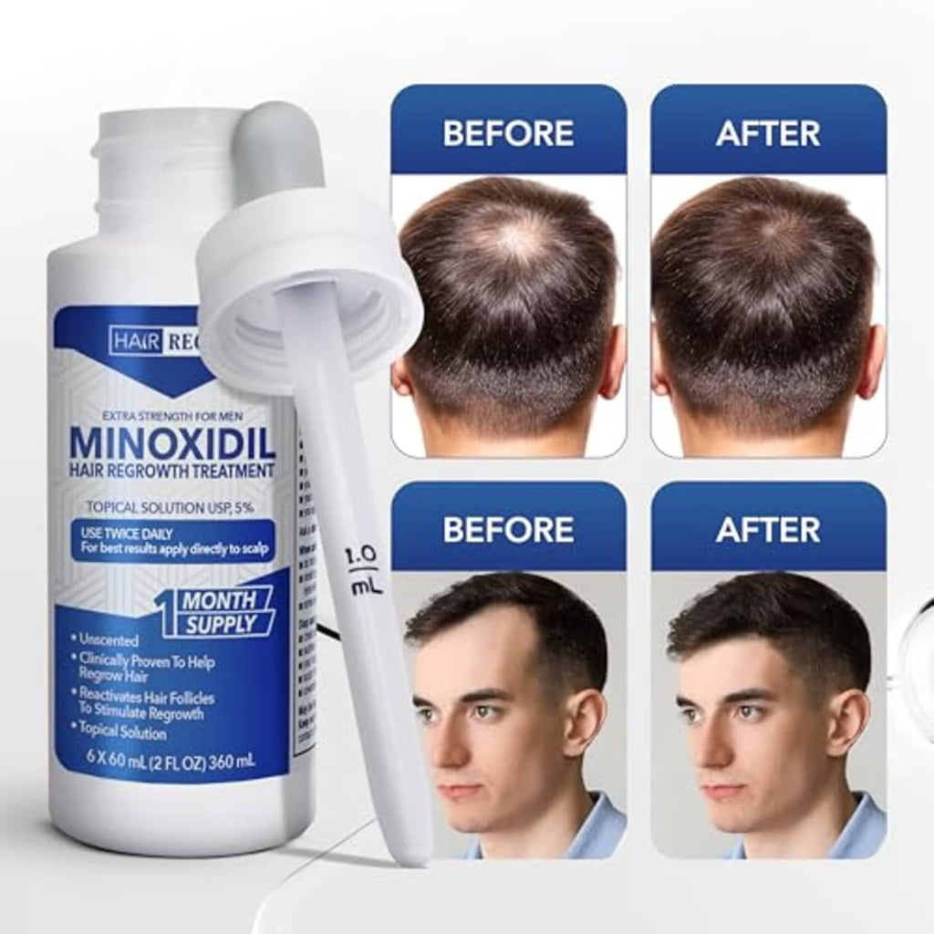 Minoxidil 5% topical solution bottle with 1.0 mL dropper for twice-daily use