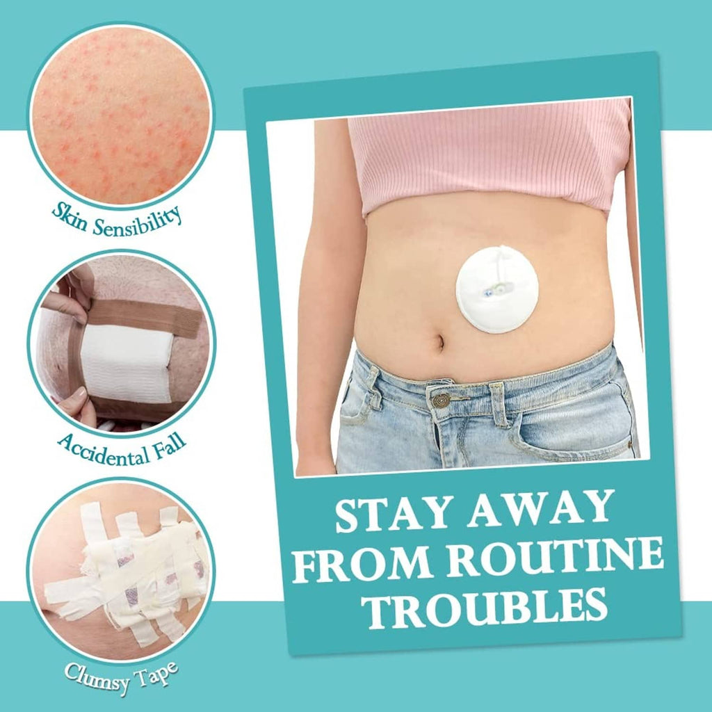 White round button cover pad on abdomen covering a tube port