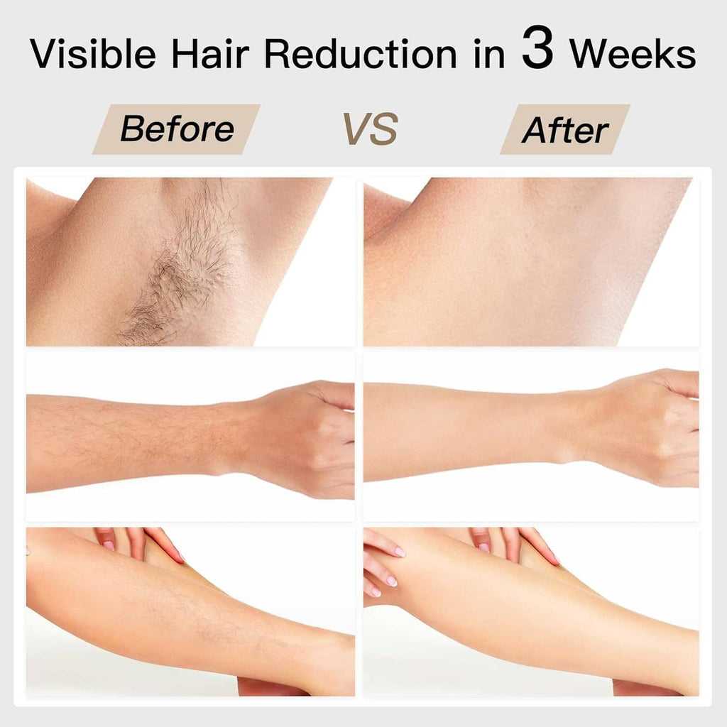 IPL hair removal results comparison on forearms, before and after panels