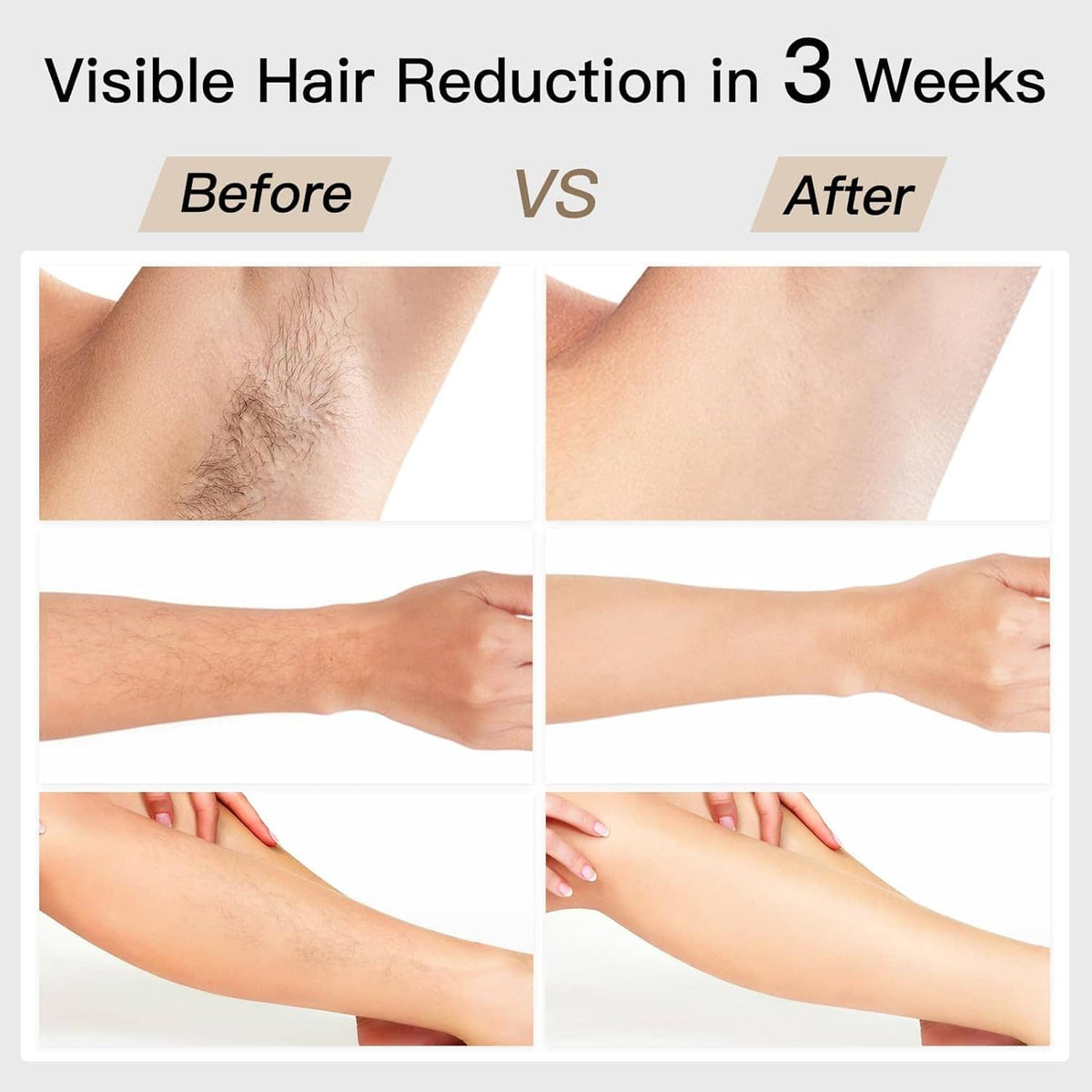 IPL hair removal results comparison on forearms, before and after panels