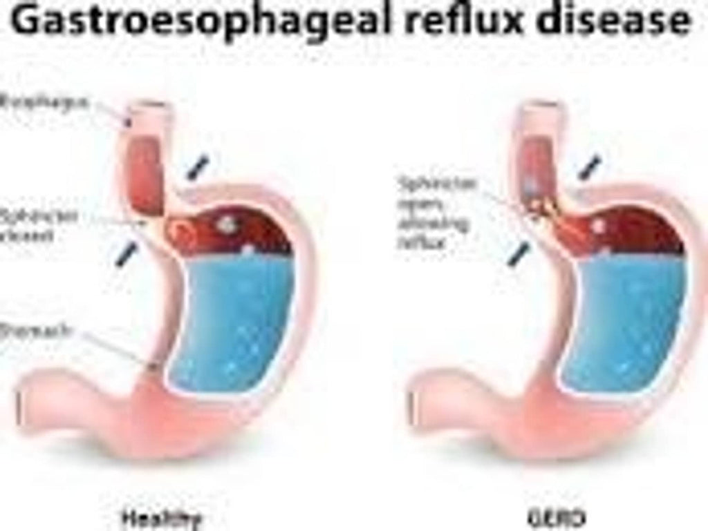 Diagram of gastroesophageal reflux disease showing stomach labeled healthy vs GERD