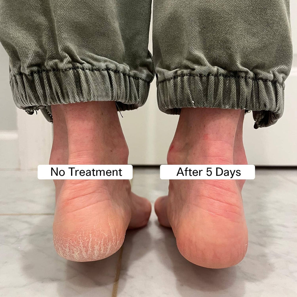 Cracked heels before-and-after comparison with foot balm treatment on bare feet