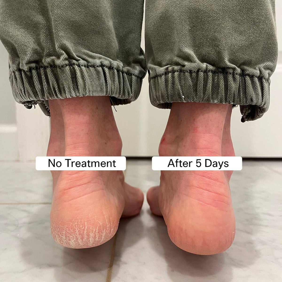 Cracked heels before-and-after comparison with foot balm treatment on bare feet