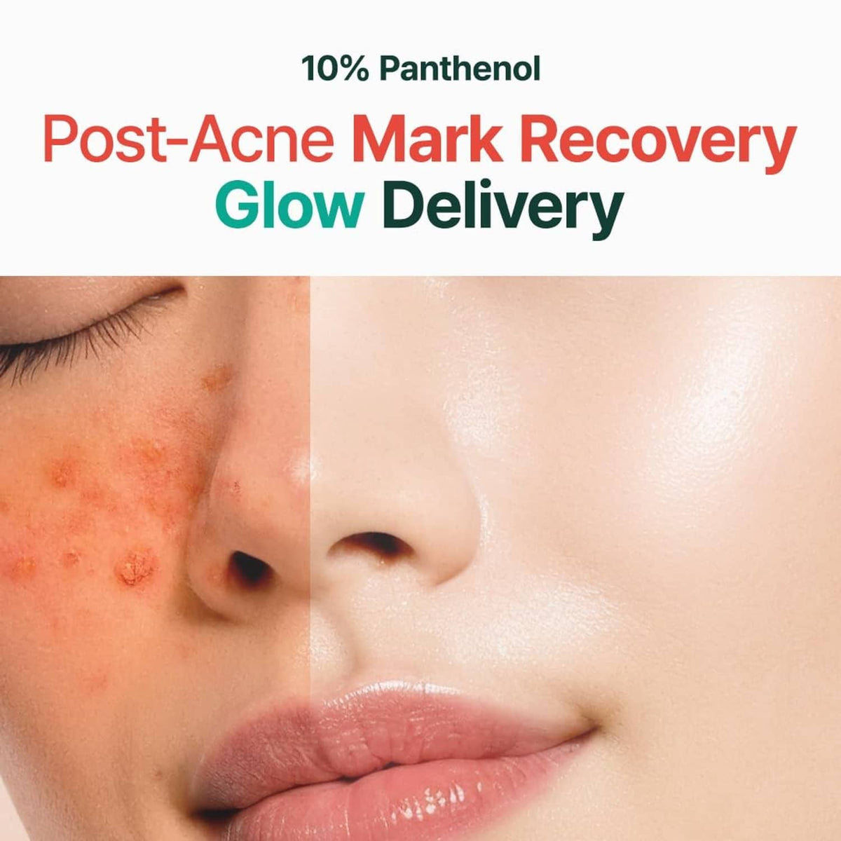 Close-up face skin with uneven marks and glow, post-acne recovery theme text