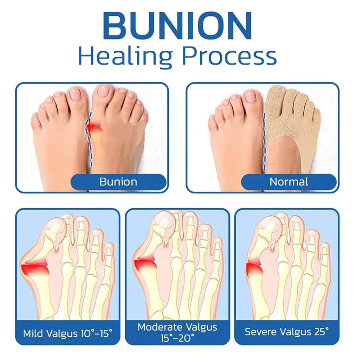 Bunion healing process diagram comparing bunion and normal foot alignment