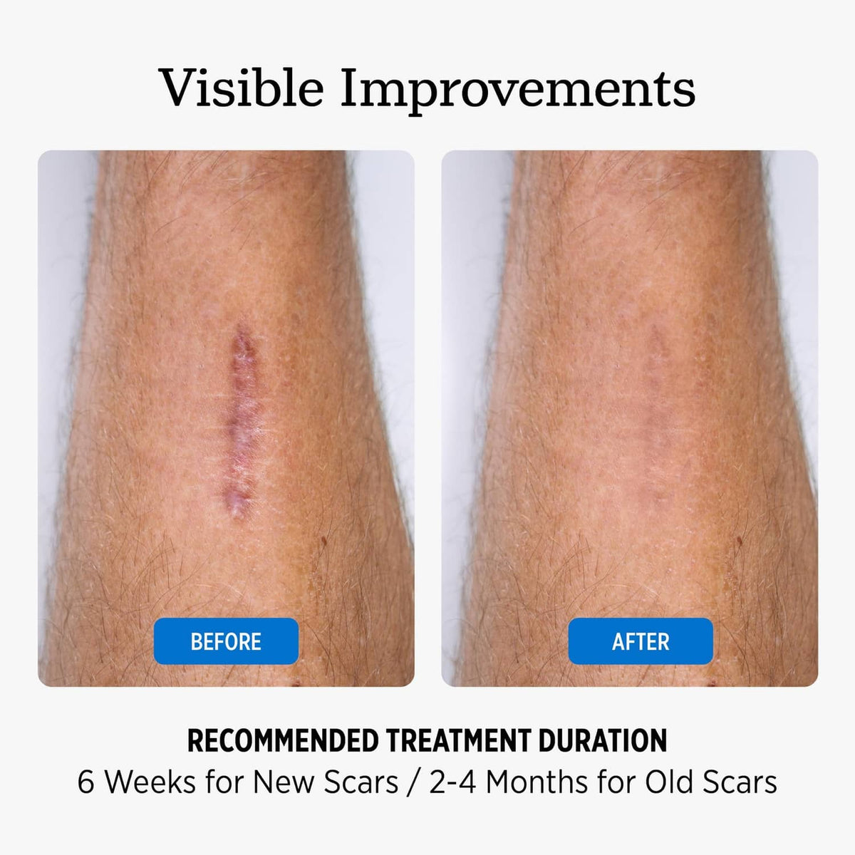 Light beige silicone sheet shown over leg scar area for after-treatment look