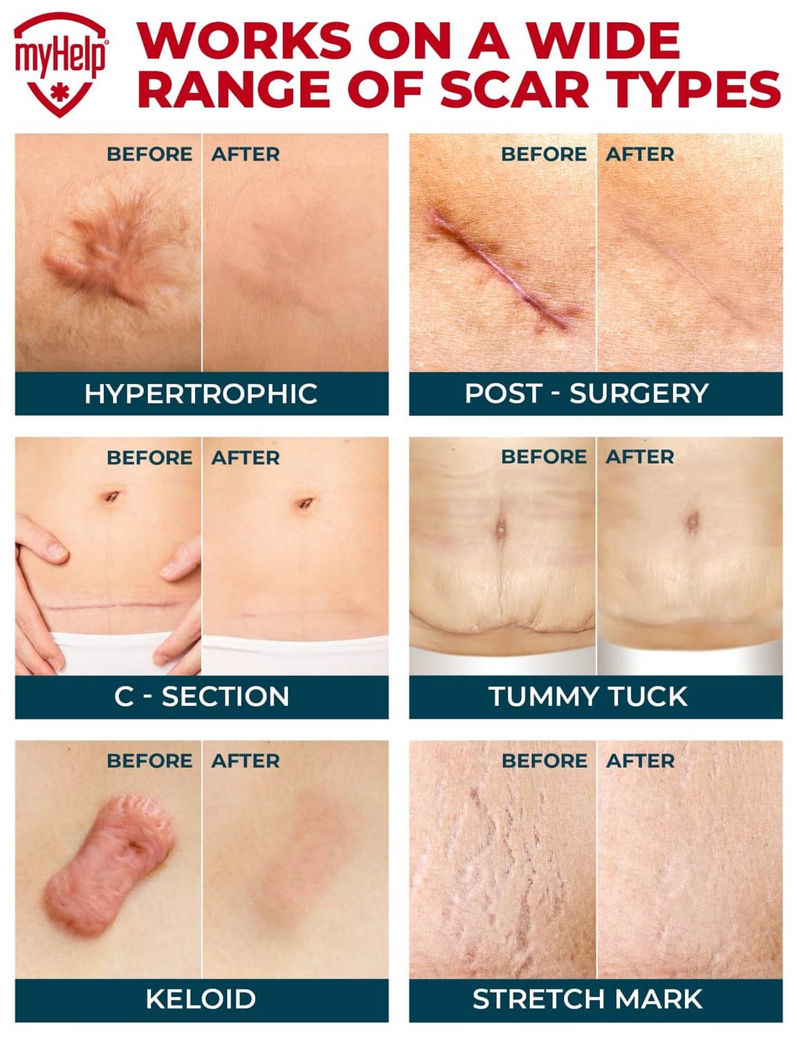 Transparent silicone scar sheets shown on multiple scar types across body areas