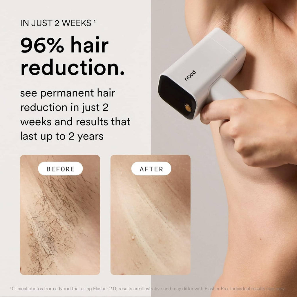 Matte white IPL device in hand, light window aimed at forearm skin for treatment