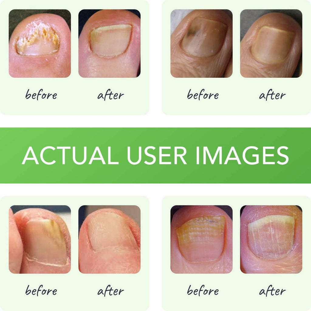 Before-and-after toenail photos with visible nail changes for a treatment formula