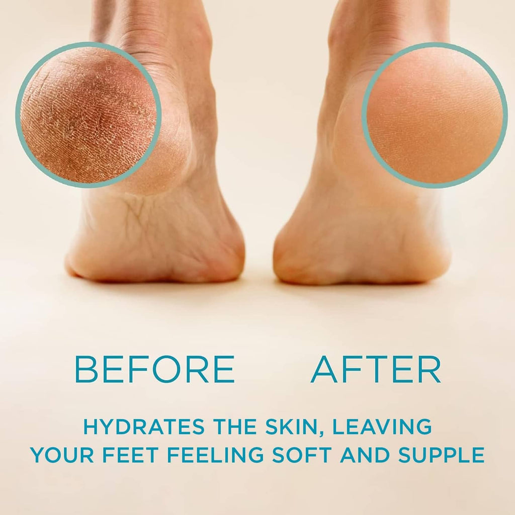 Feet with callus area highlighted on one foot and smoother skin on the other