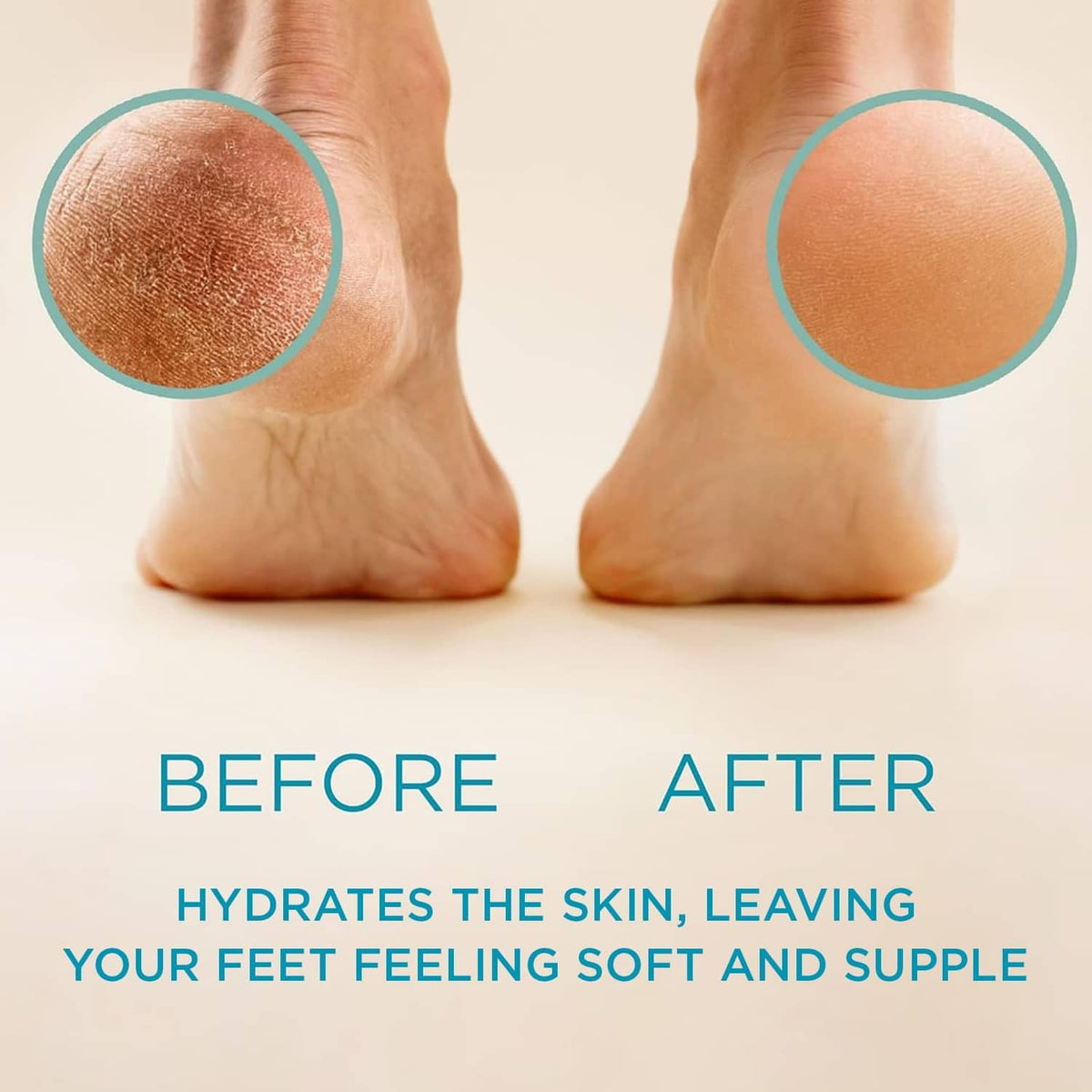 Feet with callus area highlighted on one foot and smoother skin on the other