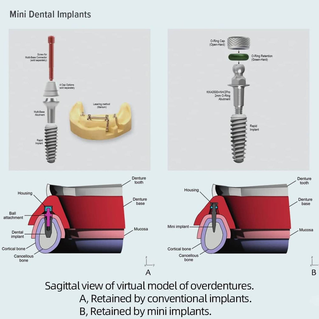 Sagittal model diagram of mini dental implant overdentures with and without retained parts