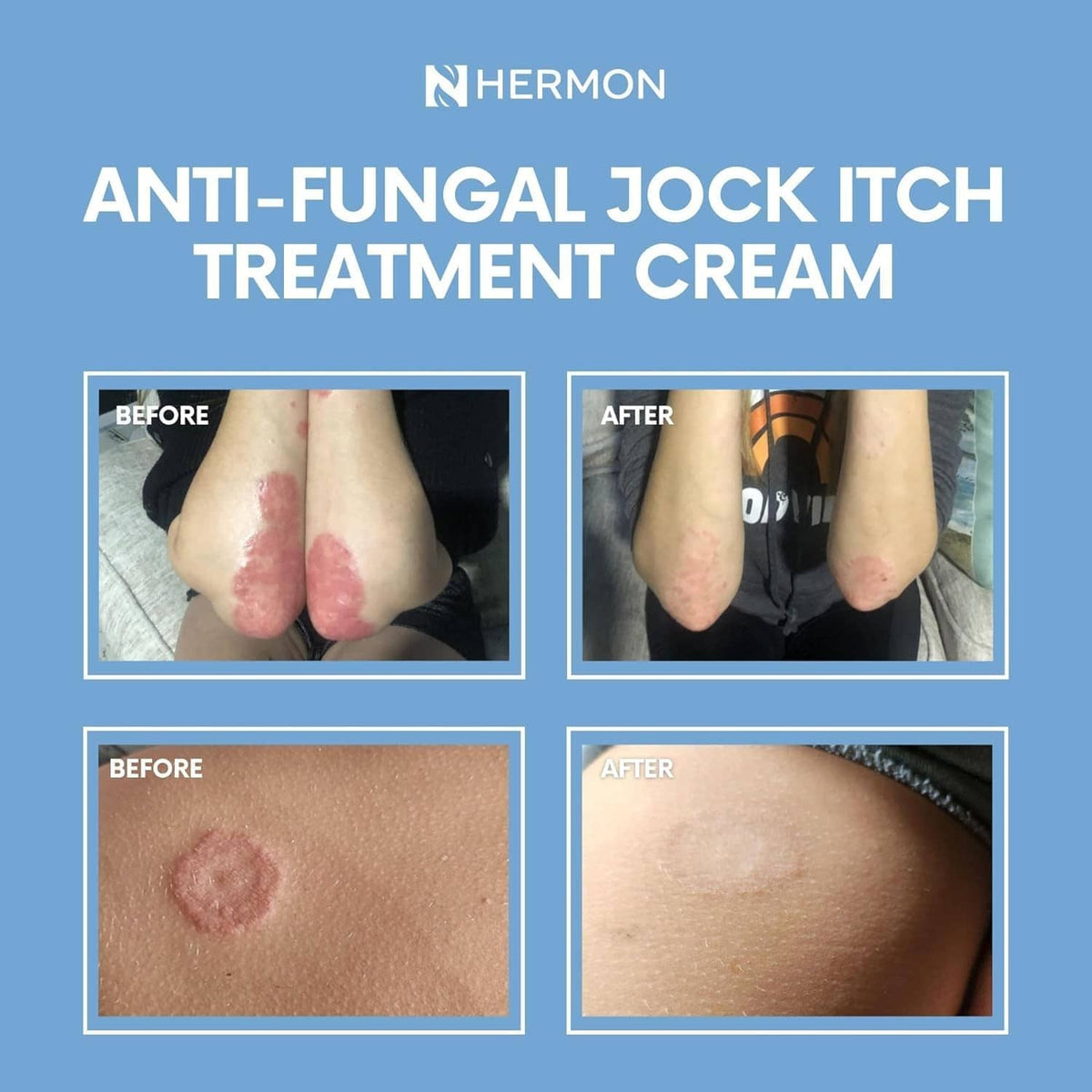 Hermon Jock Itch antifungal cream with before-and-after skin inset tiles