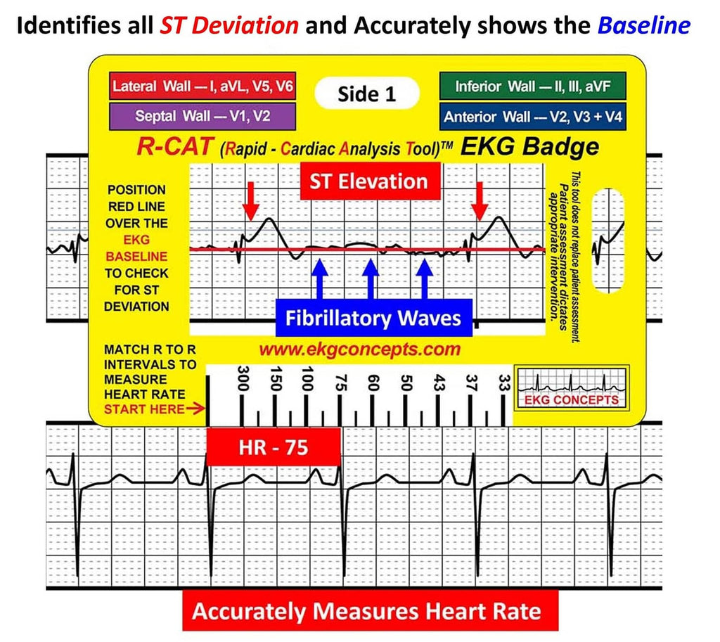 EKG analysis badge, yellow card showing ST deviation, baseline line, and fibrillatory waves