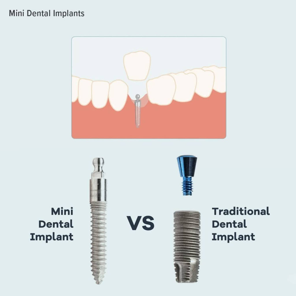 Dental implant comparison diagram: mini dental implant vs traditional dental implant